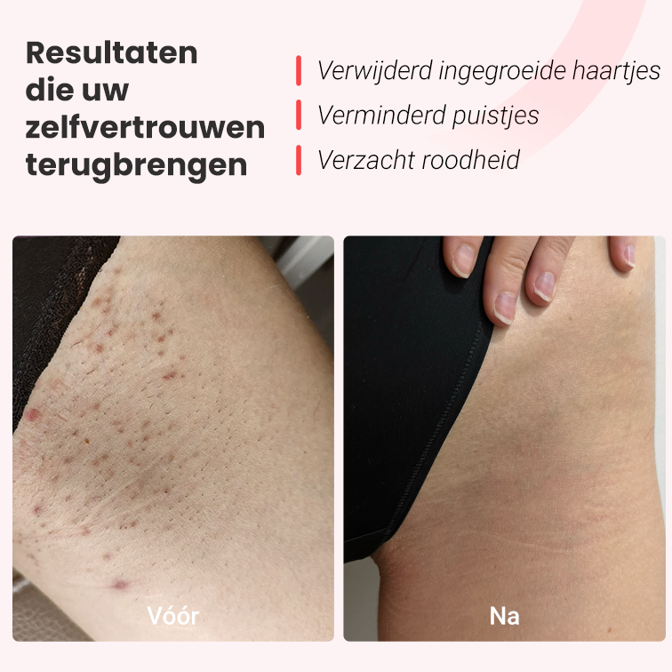 IPL foto-epilator Hilda